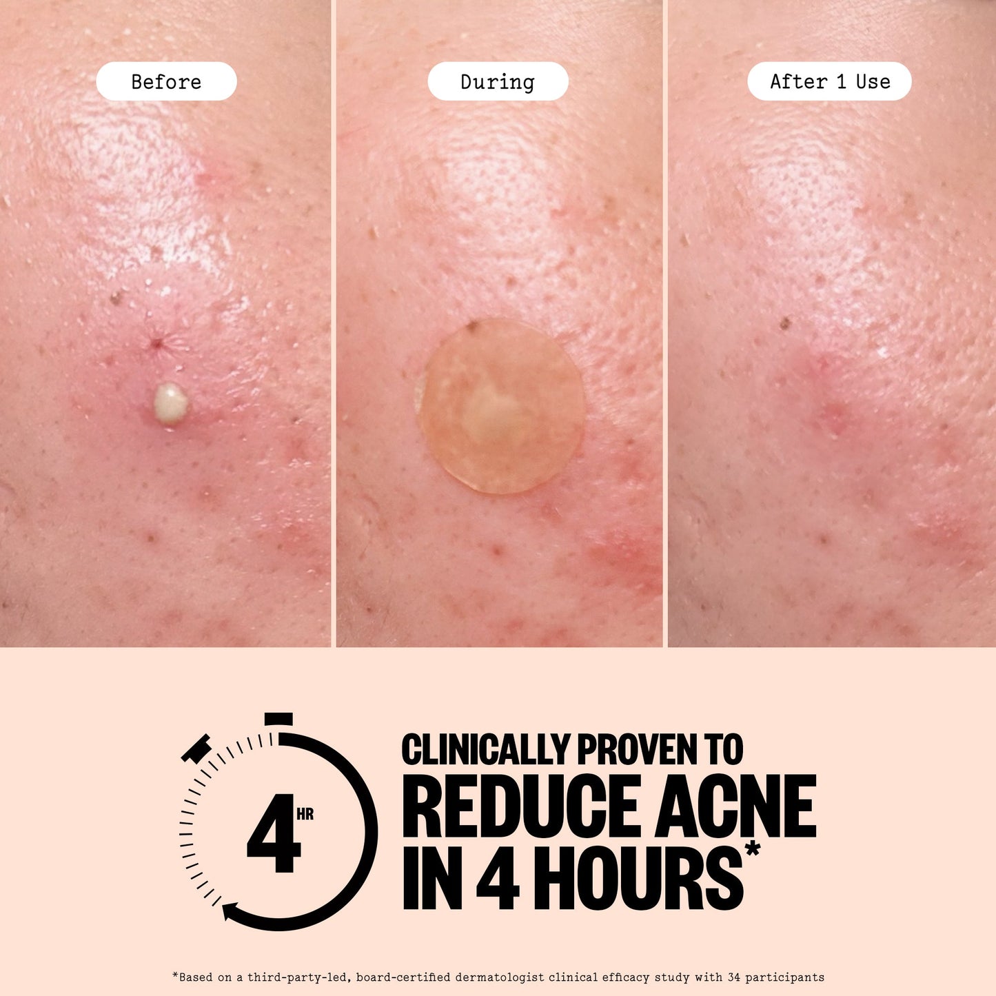 Acne Treatment 20 Dots