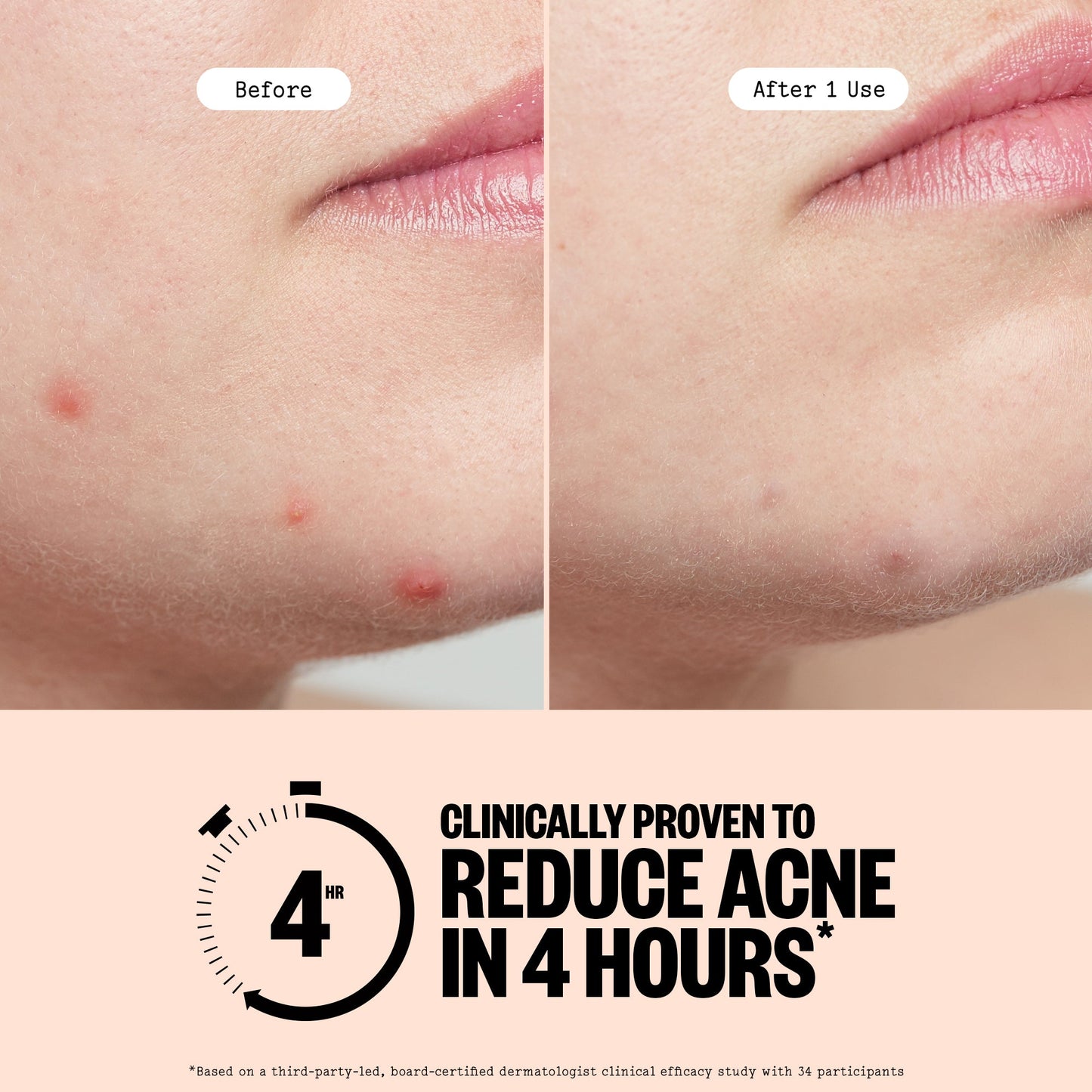 Acne Treatment 20 Dots